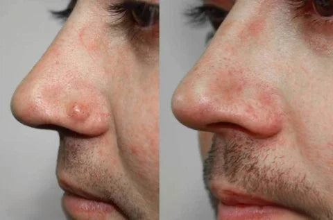 š„ODALIT⢠Natural Skin Tag and Wart Removal Patches